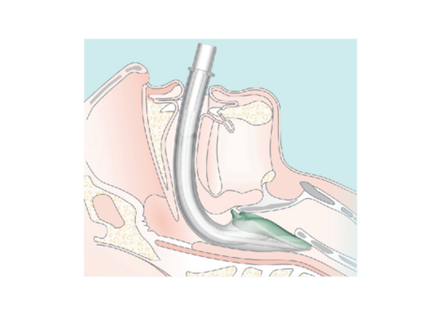 喉罩（英特賽克）